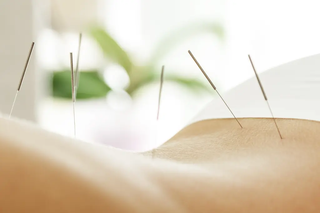 Fine acupuncture needles placed along a client's lower back in a bright, airy treatment room