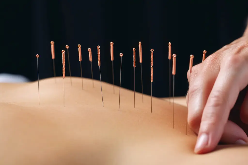 A practitioner gently placing acupuncture needles along the back