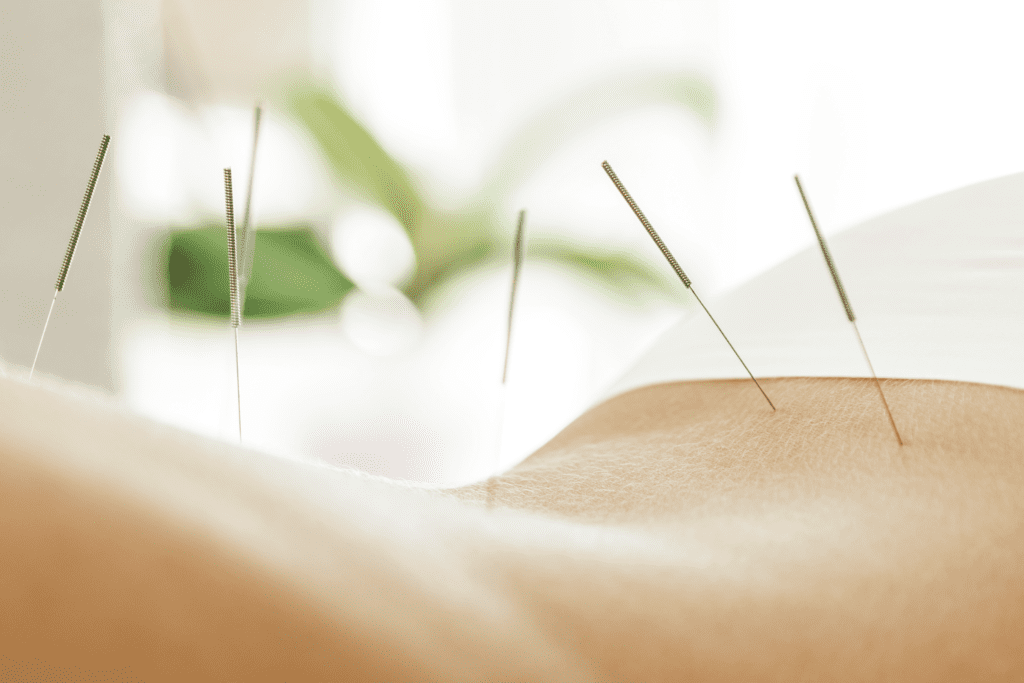 caldera wellness acupuncture lower back