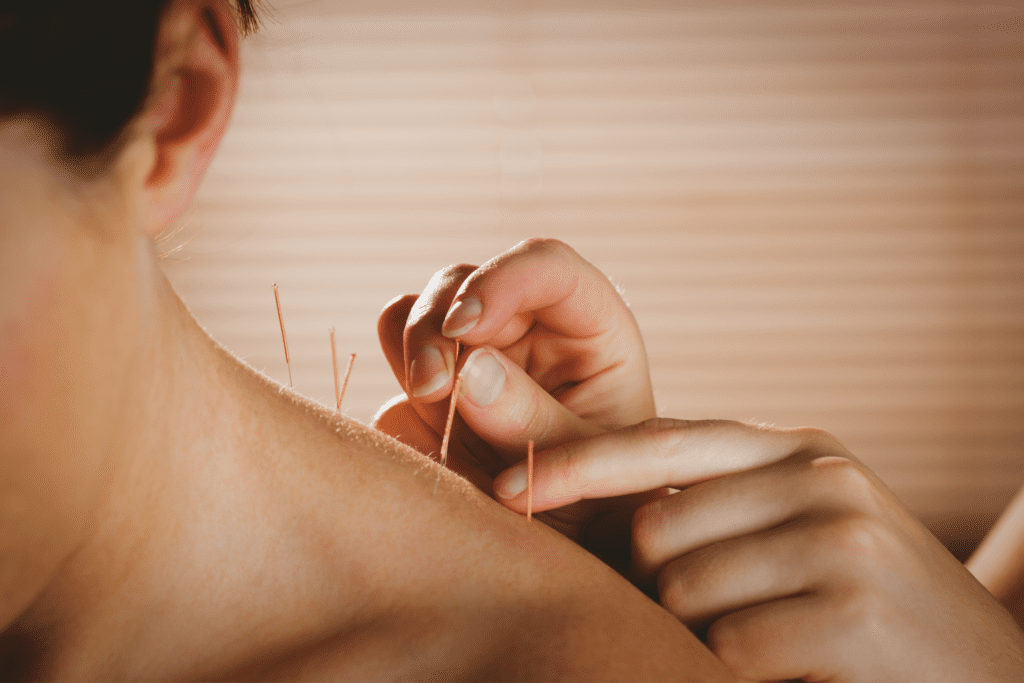 caldera wellness acupuncture shoulder