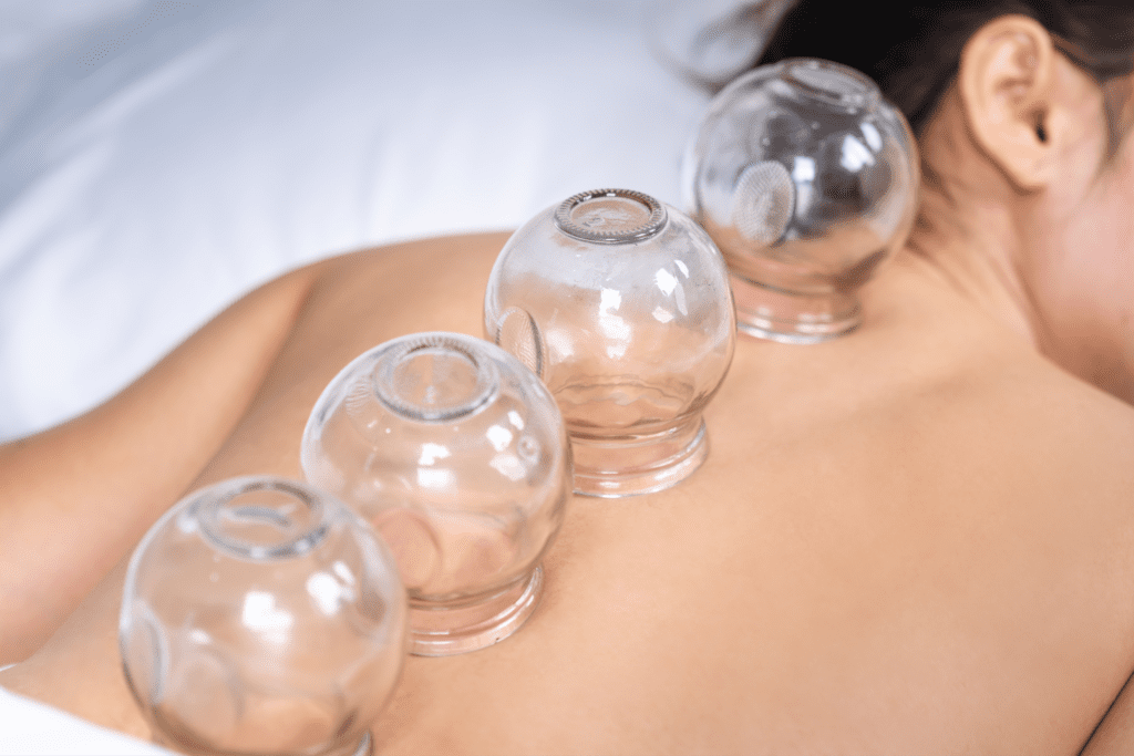 cupping therapy